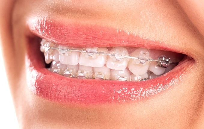 Ortodoncia. Por salud dental y estética.