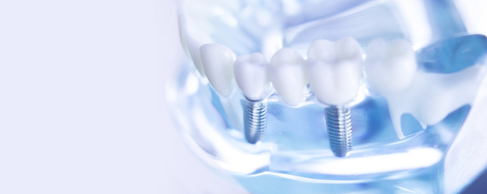 implante dental 4d