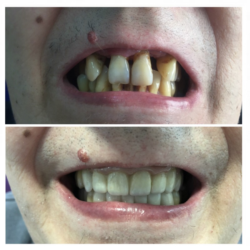 Implantes-dentales Granada