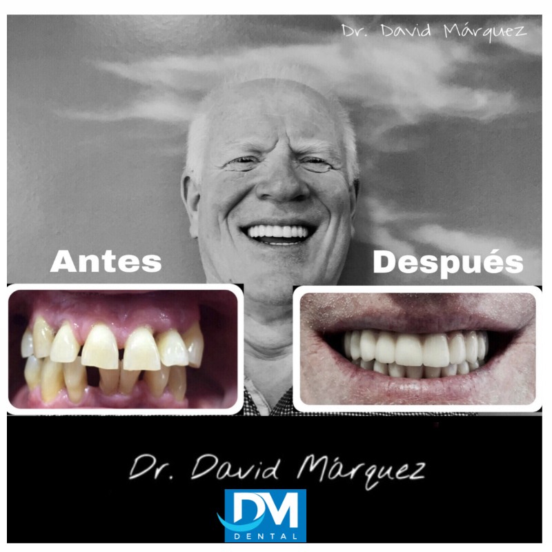 Implantes Dentales Granada
