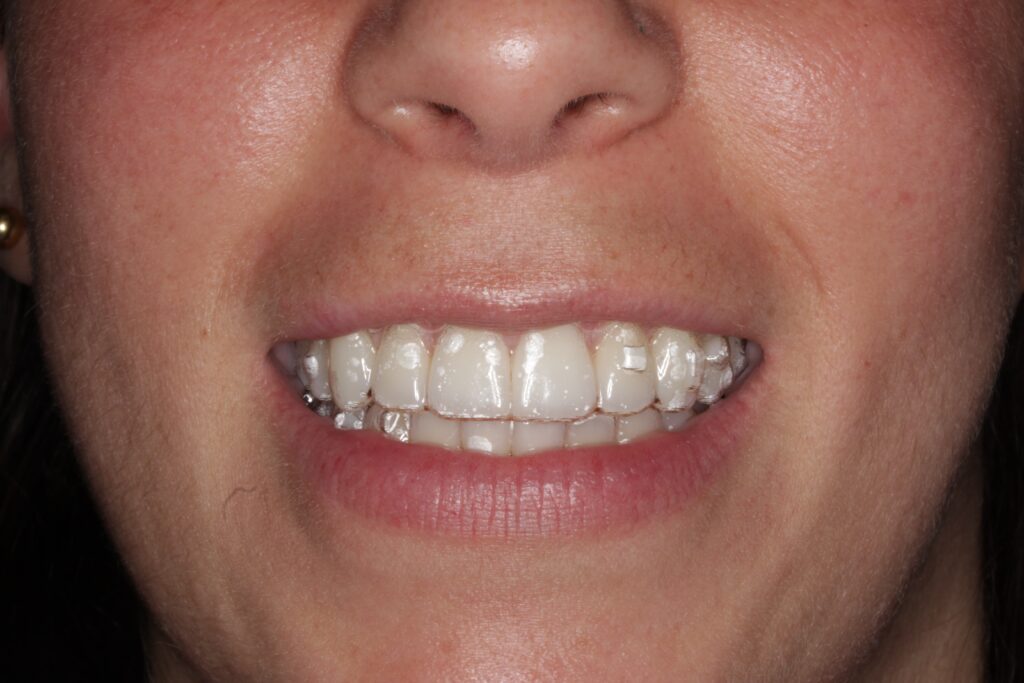 funda transparente ortodoncia invisalign