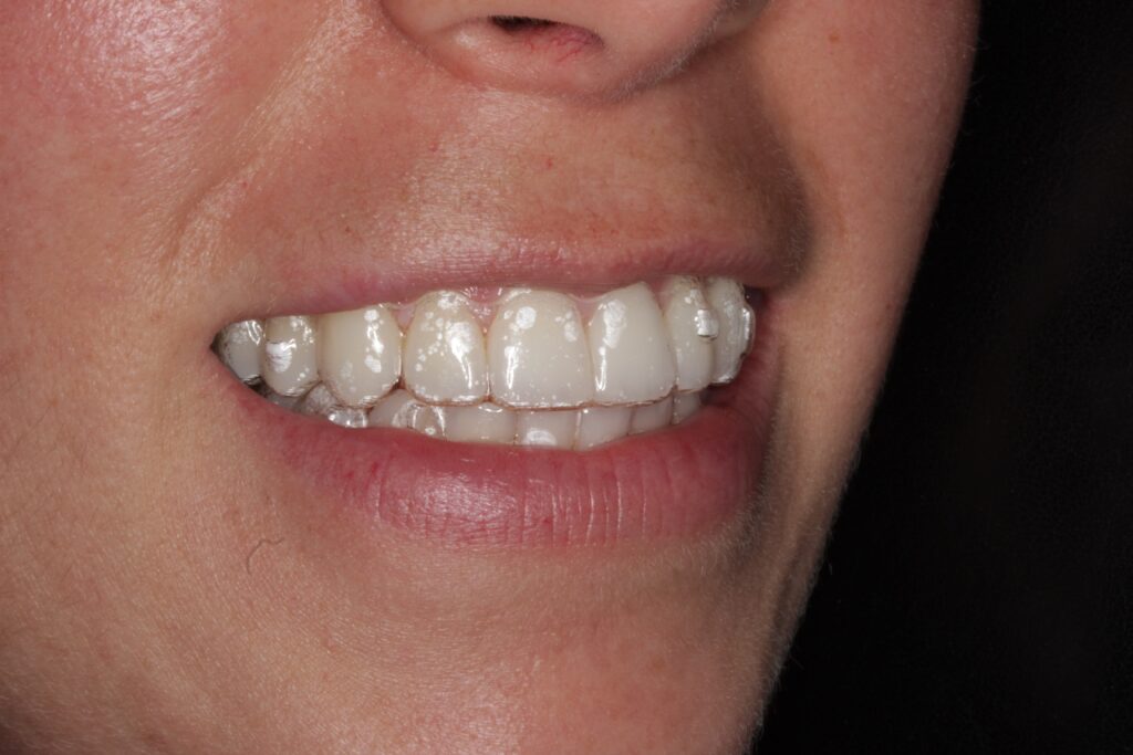 ortodoncia invisalign